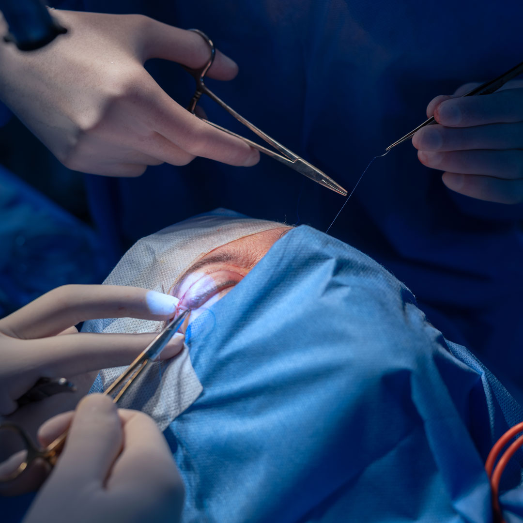 Imagen de persona sometiéndose a cirugía plástica facial, con médicos realizando el procedimiento