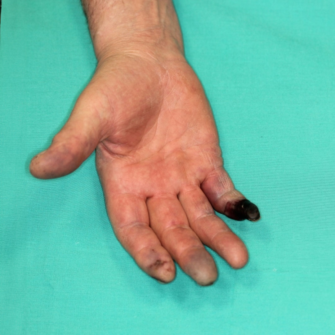 Imagen de la mano de una persona con el dedo meñique necrozado
